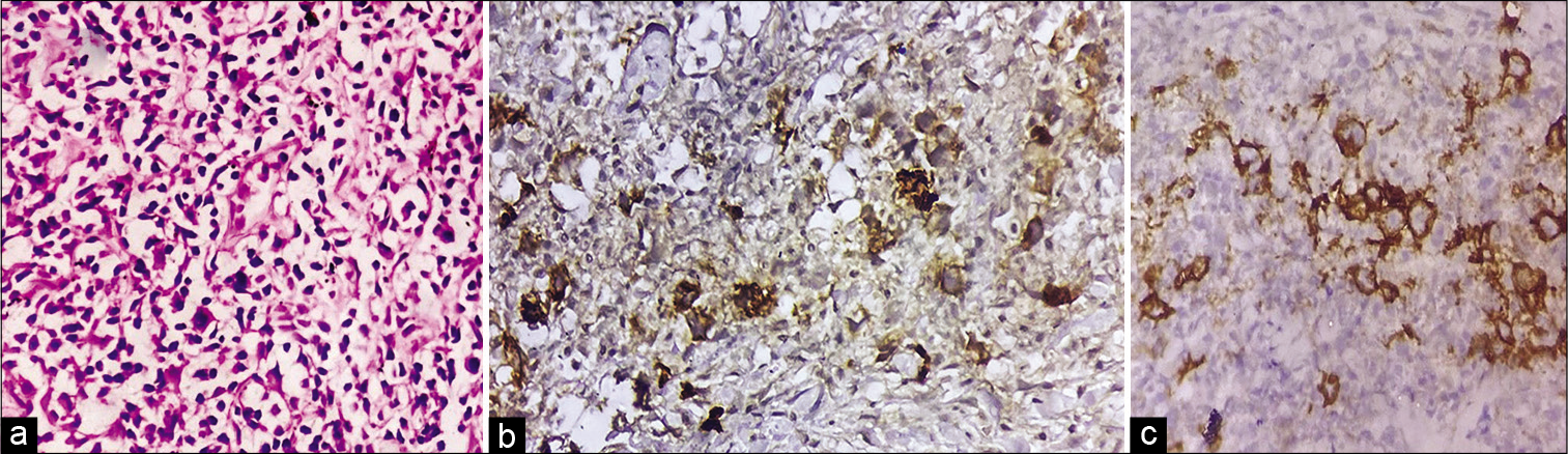 (a) H&E, ×400: Infiltration of lung parenchyma by inflammatory cells predominantly lymphocytes, with few eosinophils and scattered atypical cells with bizarre convoluted nuclei, (b) Immunohistochemistry with CD 15 (DAB Chromogen, ×400): Atypical cells are immunopositive, (c) Immunohistochemistry with CD 30 (DAB Chromogen, ×400): Atypical cells are immunopositive.