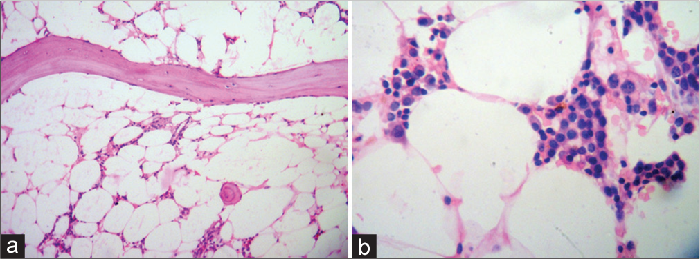 Low-power view (H&E stain; 100×) of bone marrow trephine biopsy shows hypocellular marrow with respect to age and sex (a). The high-power (H&E stain; 400×) view shows the interstitial prominence of lymphocytes and plasma cells (b).
