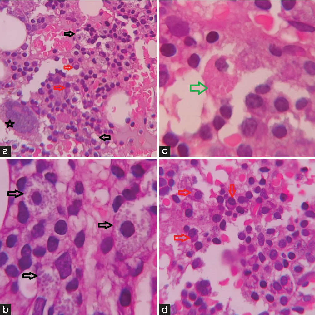 (a) Low power view of bone marrow biopsy (×100 H&E), (b-d) high power view of bone marrow biopsy showing mast cells (black arrow), plasma cells (red arrow), and crystal storing histiocytes (green arrow) (×400 H&E).