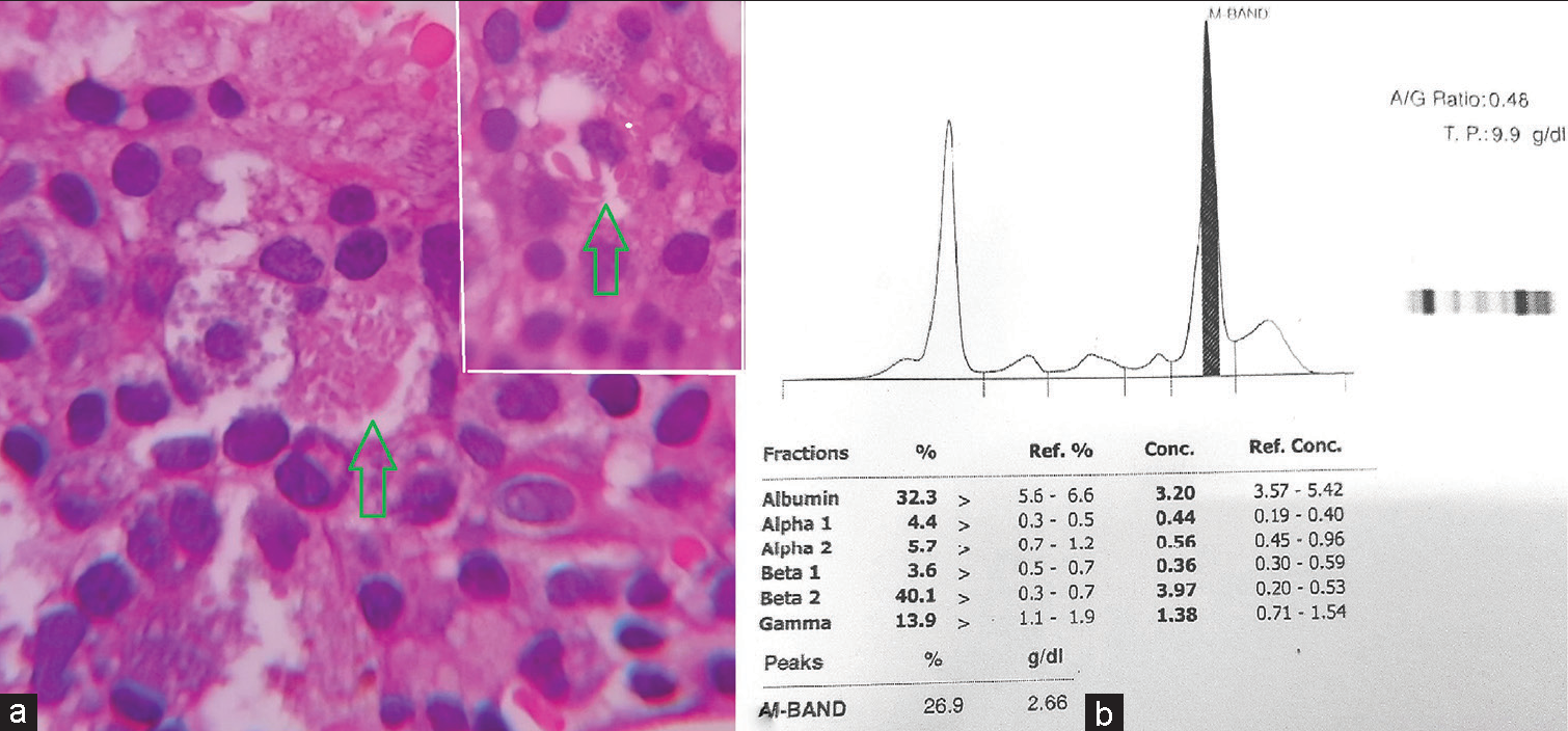 (a) High power view of a histiocyte showing needle shaped crystals (green arrow). Inset showing another similar histiocyte (×400 H&E). (b) Graph of serum protein electrophoresis depicting the monoclonal band.