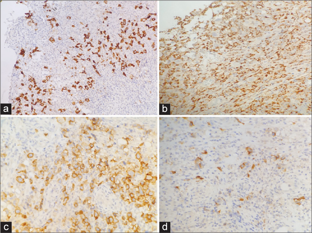 (a) Immunohistochemical study. (a) Showing CD30 positivity in large atypical cells (CD30 ×10). (b) Showing CD68 negativity in large atypical cells (CD68 ×20). (c) Showing CD19 positivity in large atypical cells (CD19 ×20). (d) Showing Epstein-Barr virus (EBV)-latent membrane protein (LMP) positivity in large atypical cells (EBV-LMP ×20).