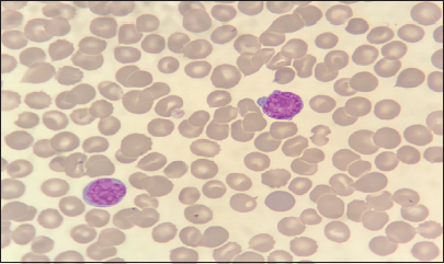 Peripheral blood smear showing atypical cells with large, irregular folded nuclei with non-distinct nucleoli.