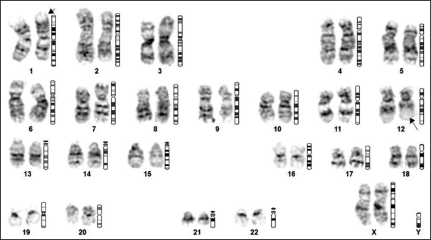 Chromosome analysis revealed 46, XX with the presence of balanced translocation between the short arm of chromosome #1 and the long arm of chromosome #12, between the regions 1p31 and 12q13, respectively, found in all the metaphases studied.