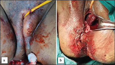 A 28-year-old female with Von Willebrand disease examined 2 h following vaginal delivery with episiotomy. (a) Left vulvar hematoma seen on inspection. (b) 350 cc clots were evacuated during vaginal exploration.