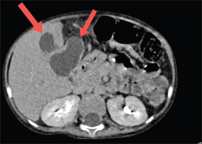 Contrast enhanced computed tomography image of abdomen showing multiple hypodense lesions in the liver (red arrows).