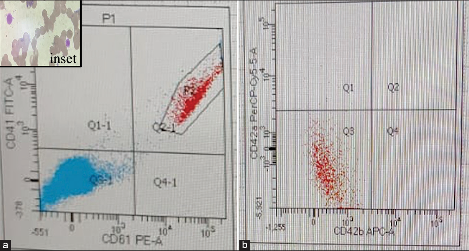 (a) Flow cytometry expression on gated paltelets (P2, Quadrant Q2-1) revealing normal expression by CD 41 (Gp IIb) FITC and CD61 (Gp III a) PE and (b) revealing absent expression by CD42a (Gp Ib -IX -V) and CD42b (Gp Ib -IX -V)(Q3 quadrant). Inset: Geimsa stained peripheral smear revealing giant platelets.