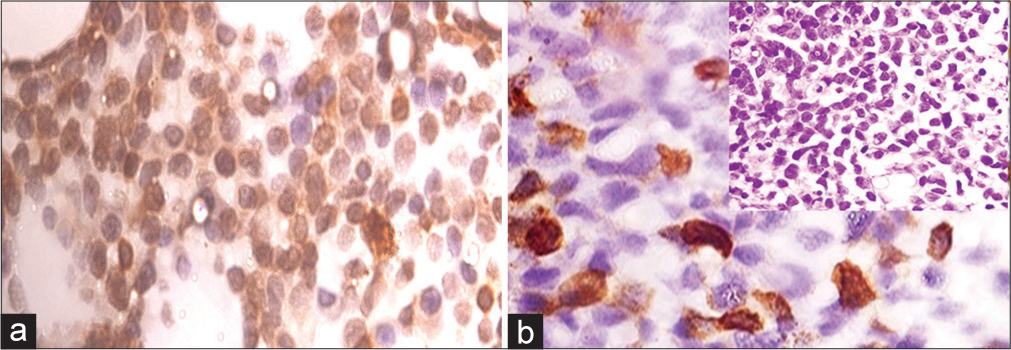 (a) Representative core biopsy stained with WT1 antibody-MPAL WT1 score = 80, ×1000 magnification (b) AML M7, WT1 score = 20, ×1000 magnification: inset bone marrow biopsy AML M7 (Hematoxylin and Eosin ×400 magnification). AML: Acute myeloid leukemia, WT1: Wilms’ tumor gene 1, MPAL: Mixed phenotype acute leukemia.