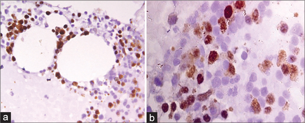 (a) Representative core biopsy stained with cyclin D1 antibody-AML (FAB M7), Cyclin D1 score = 12, ×1000 magnification (b) Immunohistochemical stain for p53 in B-ALL, p53 score = 16, ×1000 magnification. AML: Acute myeloid leukemia, B-ALL: B-cell acute lymphoblastic leukemia.
