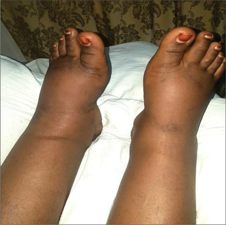 Pedal edema of both lower limbs for 30-year-old woman that reported with complain of persistent edema of both lower limb but nor skin rashes neither ulceration.