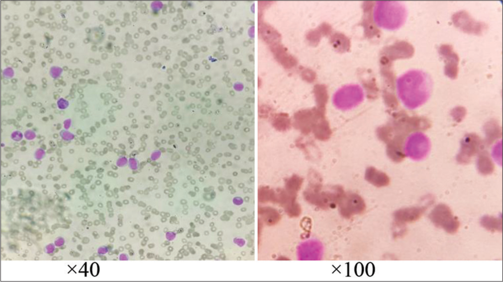 Leishman stained peripheral blood smear shows multiple microcytic hypochromic red blood cells with predominance of immature cells having high nucleo: cytoplasmic, oval to round nuclei with fine nuclear membrane having prominent nucleoli and scant blue cytoplasm.