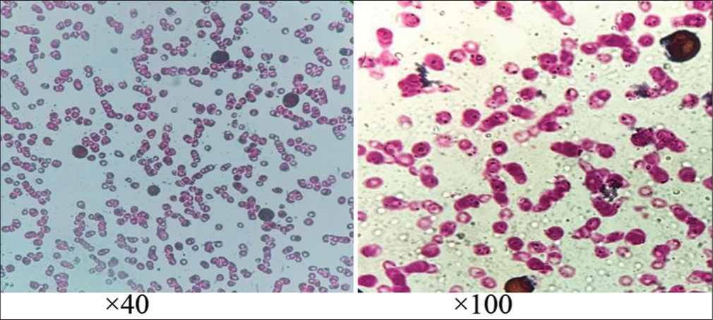 Staining by myeloperoxidase showed diffuse granular positivity proving the immature cells to be myeloblasts.