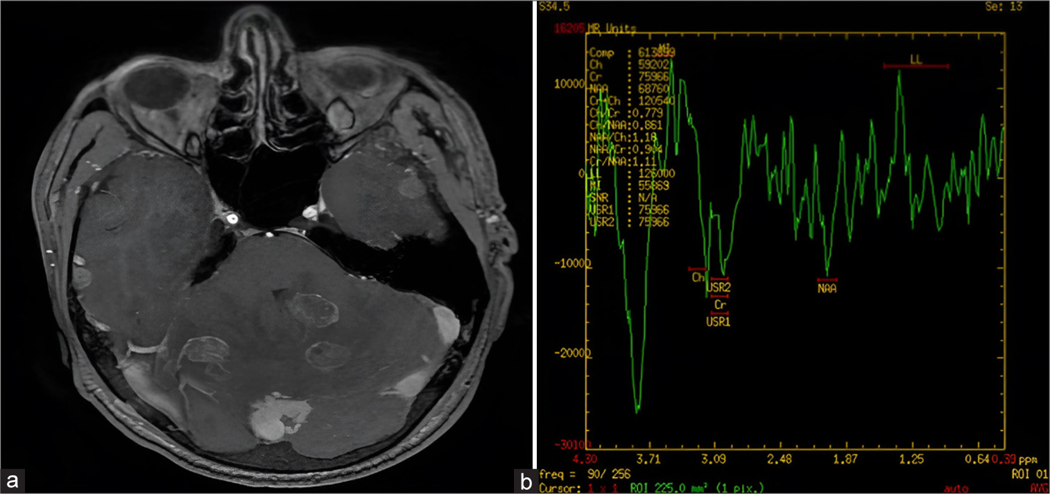 A 48-year-old male with headache and altered sensorium. (a) Contrast-enhanced magnetic resonance imaging brain image shows multiple ring-enhancing lesions with mild-to-moderate perilesional edema. (b) Magnetic resonance spectroscopy showing lipid lactate peak.