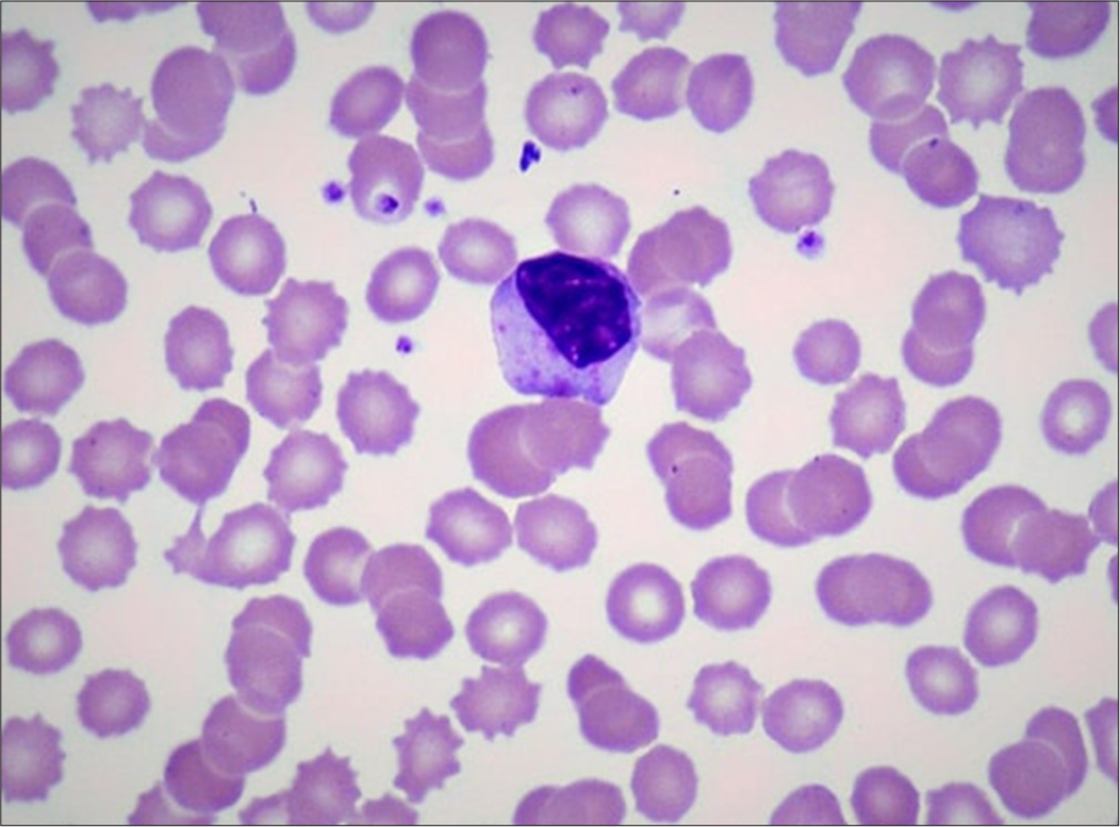 It shows large granular lymphocytes in peripheral smear (oil immersion/×100, Leishman stain).