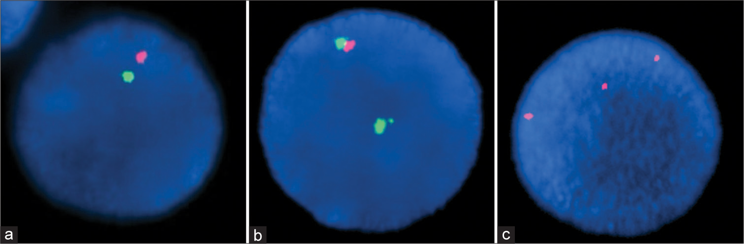 (a) An interphase cell showing one green and one orange signals interpreted as positive for 5q31.2/5q32-33.1 deletion. (b) An interphase cell showing two green and one orange signals interpreted as positive for 20q12-q13.3 deletion. (c) An interphase cell showing three orange signals interpreted as positive for trisomy 8.