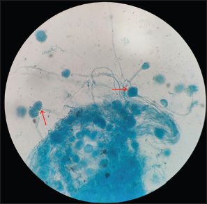 Lactophenol cotton blue mount from the culture at 40× magnification showing growth of Aspergillus fumigatus species (red arrows).