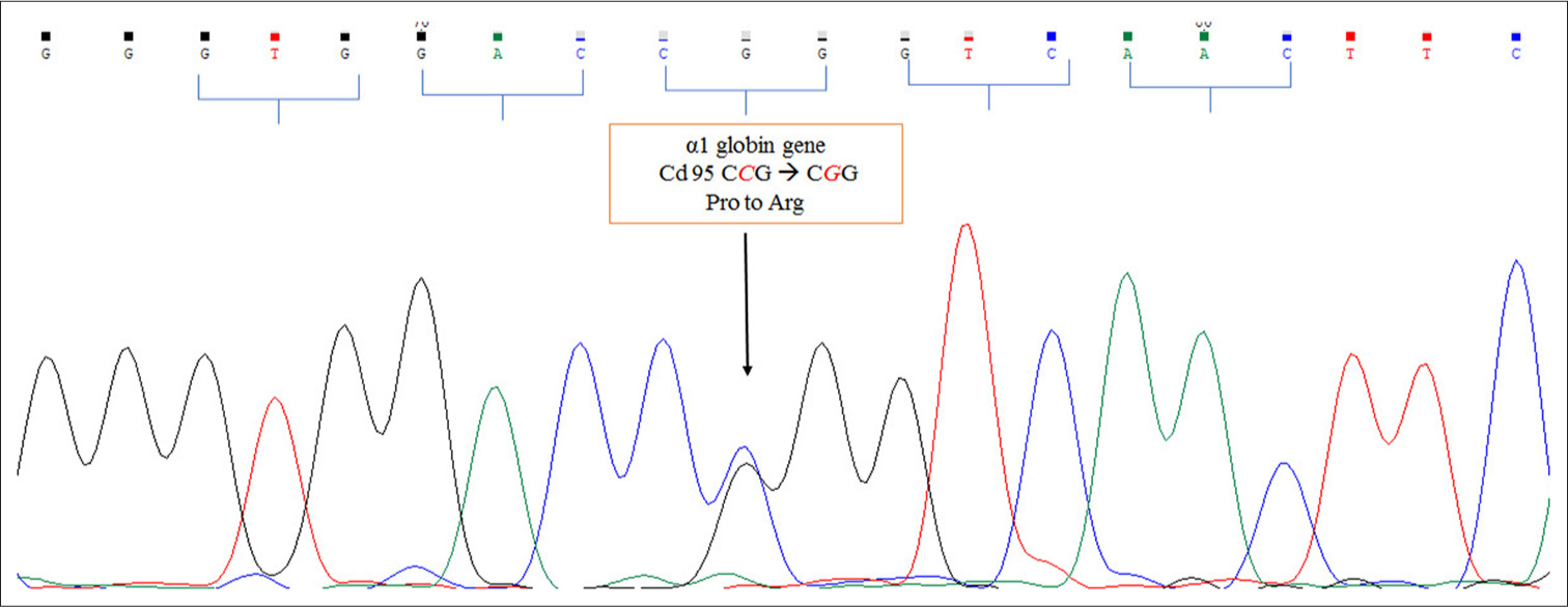 Deoxyribonucleic acid sequencing of α-globin gene showing hemoglobin St. Luke’s [α95[G2]Pro→Arg]. A: Adenine, G: Guanine, C: Cytosine, T: Thymine, Pro: Proline , Arg : Arginine.