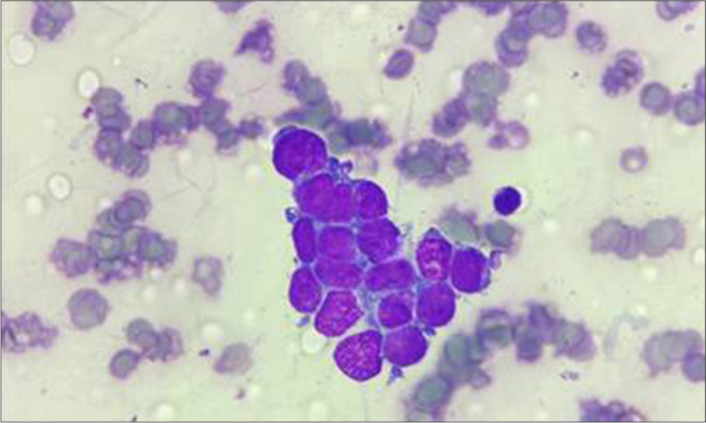 Bone marrow aspirate smears show clusters of round blue cells. Hematoxylin and eosin (200x)