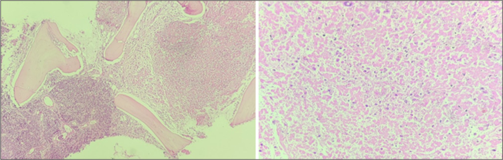 Bone marrow biopsy with area of involvement by abnormal cells and large area of necrosis.