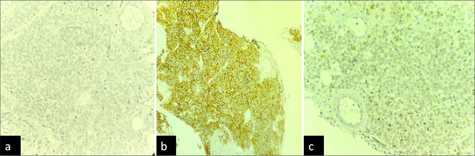 (a) CD45 immunostain negative in abnormal cells. (b) CD99 immunostain strong positive. (c) NKX 2.2 focal positivity.