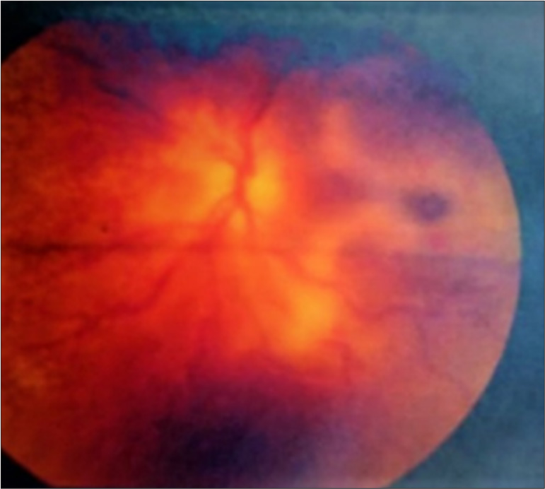 On fundus examination, optic disc was pale with distinct margin with cherry red spot.