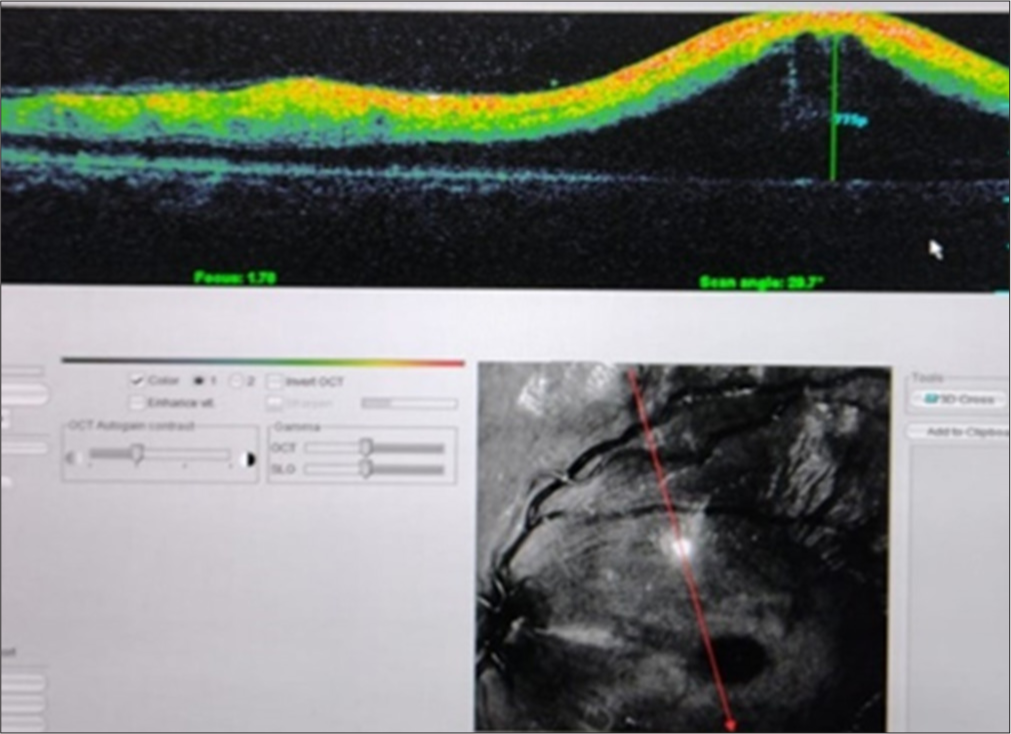 Ocular coherence tomography showing raised macular contour (7.15 µm).