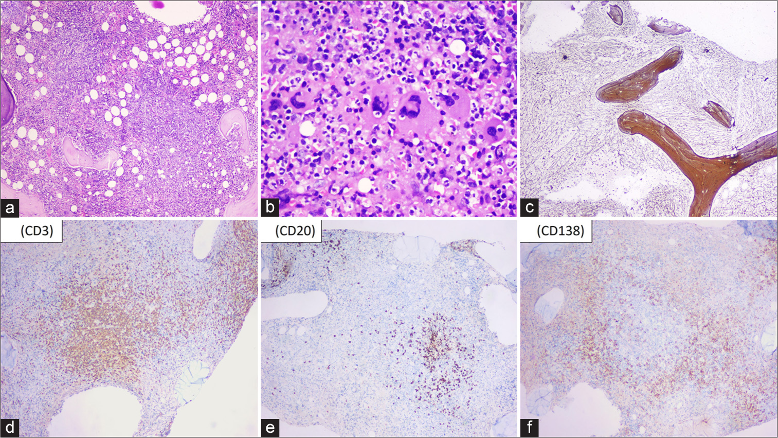 (a) Bone marrow biopsy shows hypercellular marrow with large nodular aggregates composed of small lymphoid cells surrounded by a rim of plasma cells (×40; Hematoxylin and Eosin [H&E]). (b) Bone marrow biopsy shows megakaryocytic hyperplasia forming loose clusters with few monolobated forms (×400; H & E). (c) Reticulin stain highlights diffuse World Health Organization grade 2 fibrosis (×40). (d and e) CD3 and CD20 highlights the lymphoid aggregates in the marrow (×40). (f) CD138 highlights the plasma cells aggregates in the interstitium forming a rim around the lymphoid nodules (×40).