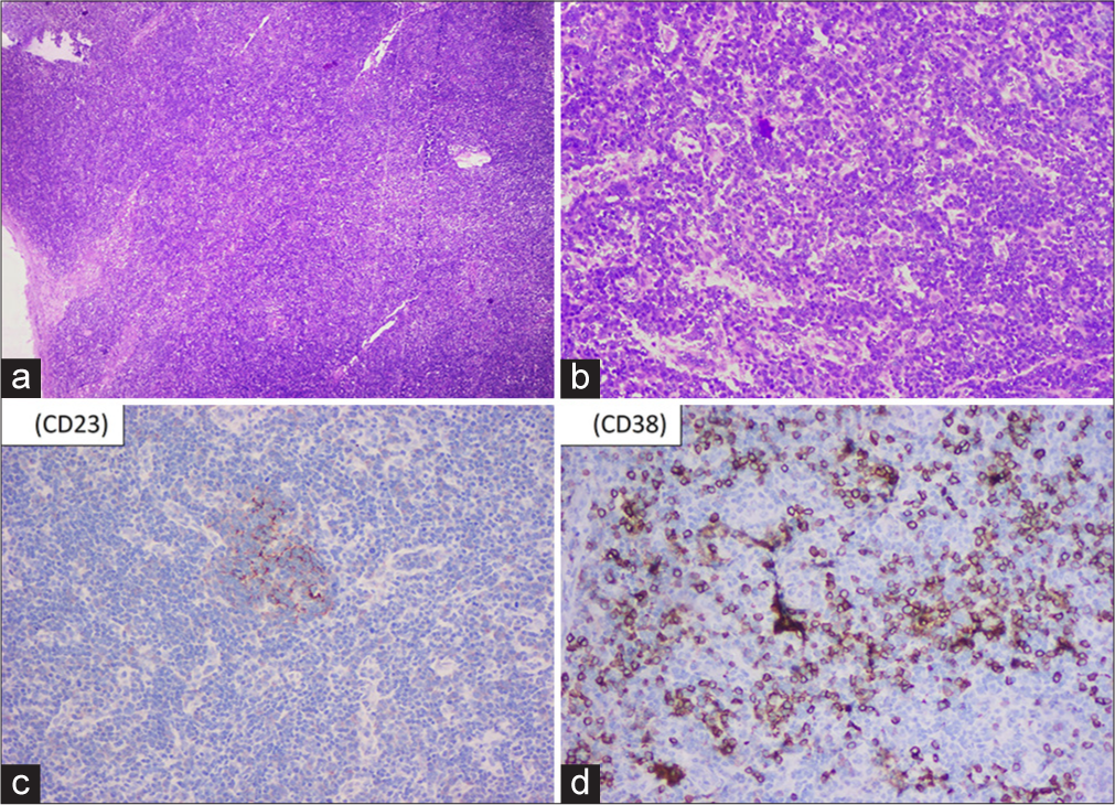 (a and b) Lymph node biopsy shows paracortical expansion by sheets of plasma cells with prominent vasculature accompanied by regressed follicles (a– ×40; Hematoxylin and Eosin [H&E], b– ×100; H&E). (c) CD23 highlights the dendritic cells in the regressed follicles (×100). (d) CD38 highlights the plasma cells in the paracortical region (×100).