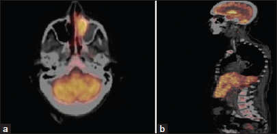 (a) Left ethmoid sinus involvement in positron emission tomography computed tomography (PET-CT). (b) Liver, spleen, and bone marrow involvement in PET-CT.